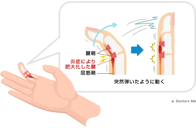 ばね指